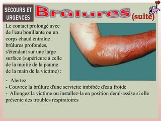 Le contact prolongé avec
de l'eau bouillante ou un
corps chaud entraîne :
brûlures profondes,
s'étendant sur une large
surface (supérieure à celle
de la moitié de la paume
de la main de la victime) :
- Alertez
- Couvrez la brûlure d'une serviette imbibée d'eau froide
- Allongez la victime ou installez-la en position demi-assise si elle
présente des troubles respiratoires
 