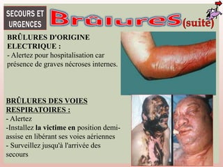 BRÛLURES D'ORIGINE
ELECTRIQUE :
- Alertez pour hospitalisation car
présence de graves nécroses internes.
BRÛLURES DES VOIES
RESPIRATOIRES :
- Alertez
-Installez la victime en position demi-
assise en libérant ses voies aériennes
- Surveillez jusqu'à l'arrivée des
secours
 