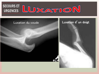 Luxation du coude Luxation d’un doigt
 