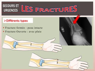  Fracture fermée : peau intacte
 Fracture Ouverte : avec plaie
Différents types
 