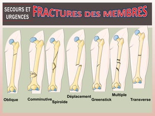 Oblique Comminutive
Spiroïde
Déplacement
Greenstick
Multiple
Transverse
 