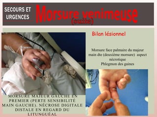 MORSURE MAJEUR GAUCHE EN
PREMIER (PERTE SENSIBILITÉ
MAIN GAUCHE). NÉCROSE DIGITALE
DISTALE EN REGARD DU
LITUNGUÉAL
Morsure face palmaire du majeur
main dte (deuxième morsure) aspect
nécrotique
Phlegmon des gaines
Bilan lésionnel
 