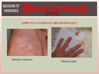 ASPECTS CLINIQUES DES MORSURES
Morsure couleuvre
Morsure aspic
 