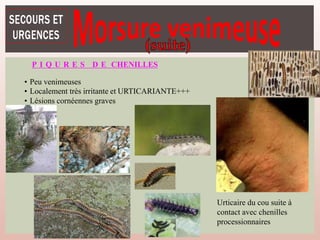 P I Q U R E S D E CHENILLES
• Peu venimeuses
• Localement très irritante et URTICARIANTE+++
• Lésions cornéennes graves
Urticaire du cou suite à
contact avec chenilles
processionnaires
 