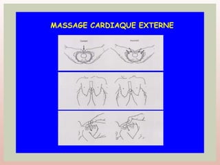 MASSAGE CARDIAQUE EXTERNE
 