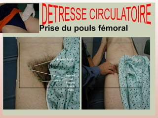 Prise du pouls fémoral
 
