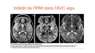 Intérêt de l'IRM dans l'AVC aigu
 