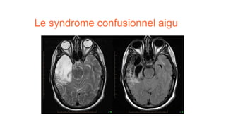 Le syndrome confusionnel aigu
 