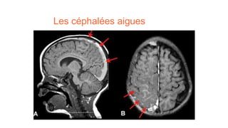 Les céphalées aigues
 