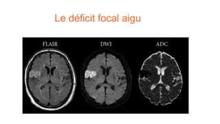 Le déficit focal aigu
 