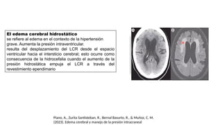El edema cerebral hidrostático
se refiere al edema en el contexto de la hipertensión
grave. Aumenta la presión intraventricular.
resulta del desplazamiento del LCR desde el espacio
ventricular hacia el intersticio cerebral; esto ocurre como
consecuencia de la hidrocefalia cuando el aumento de la
presión hidrostática empuja el LCR a través del
revestimiento ependimario
Piano, A., Zurita Santisteban, R., Bernal Basurto, R., & Muñoz, C. M.
(2023). Edema cerebral y manejo de la presión intracraneal
 