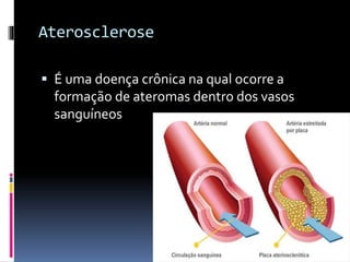 Aterosclerose
 É uma doença crônica na qual ocorre a
formação de ateromas dentro dos vasos
sanguíneos
 