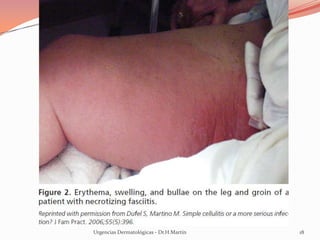 Urgencias Dermatológicas - Dr.H.Martín 18
 