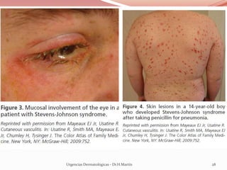Urgencias Dermatológicas - Dr.H.Martín 28
 