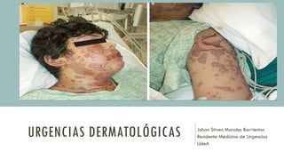 URGENCIAS DERMATOLÓGICAS Johan Stiven Morales Barrientos
Residente Medicina de Urgencias
UdeA
 