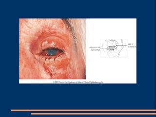 Derivar a Hospital.... Fiebre, fluctuante, alt. MO,  ↓  agudeza visual.  