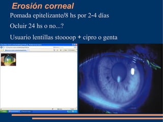 Antihistaminico  ( Opatanol 11e )  1 / 12 hs x 1 semana 