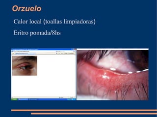 Ojo rojo no doloroso 