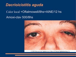 Orzuelo Calor local  ( toallas limpiadoras ) 