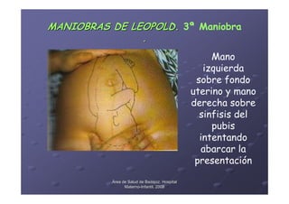 MANIOBRAS DE LEOPOLD. 3ª Maniobra
               .
                                                    Mano
                                                  izquierda
                                                sobre fondo
                                               uterino y mano
                                               derecha sobre
                                                 sinfisis del
                                                    pubis
                                                 intentando
                                                 abarcar la
                                                presentación

          Área de Salud de Badajoz. Hospital
                Materno-Infantil. 2008
                Materno-
 