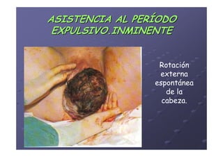 ASISTENCIA AL PERÍODO
 EXPULSIVO.INMINENTE


                                            Rotación
                                            externa
                                           espontánea
                                              de la
                                             cabeza.




      Área de Salud de Badajoz. Hospital
            Materno-Infantil. 2008
            Materno-
 