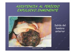 ASISTENCIA AL PERÍODO
 EXPULSIVO.INMINENTE



                                           Salida del
                                            hombro
                                            anterior




      Área de Salud de Badajoz. Hospital
            Materno-Infantil. 2008
            Materno-
 