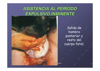 ASISTENCIA AL PERÍODO
 EXPULSIVO.INMINENTE


                                             Salida de
                                              hombro
                                            posterior y
                                             resto del
                                           cuerpo fetal.




      Área de Salud de Badajoz. Hospital
            Materno-Infantil. 2008
            Materno-
 