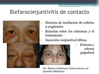 Blefaroconjuntivitis de contacto
            •     Historia de instilación de colirios
                  o ungüentos
            •     Relación entre los síntomas y el
                  tratamiento
            •     Inyección conjuntival difusa.
                                        • Eritema y
                                              edema
                                           palpebral



                Tto: Retirar el fármaco, hidrocortisona en
                pomada (oftálmica)
 