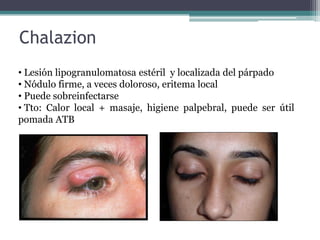 Chalazion
• Lesión lipogranulomatosa estéril y localizada del párpado
• Nódulo firme, a veces doloroso, eritema local
• Puede sobreinfectarse
• Tto: Calor local + masaje, higiene palpebral, puede ser útil
pomada ATB
 