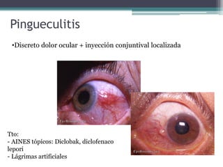 Pingueculitis
 •Discreto dolor ocular + inyección conjuntival localizada




Tto:
- AINES tópicos: Diclobak, diclofenaco
lepori
- Lágrimas artificiales
 