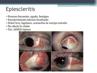 Epiescleritis
• Proceso frecuente, agudo, benigno
• Enrojecimiento intenso localizado
• Dolor leve, lagrimeo, sensación de cuerpo extraño
• No afecta la visión
• Tto: AINES tópicos
 