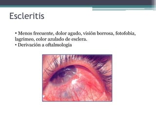 Escleritis
 • Menos frecuente, dolor agudo, visión borrosa, fotofobia,
 lagrimeo, color azulado de esclera.
 • Derivación a oftalmología
 