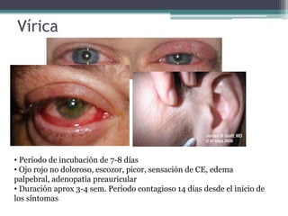 Vírica




• Período de incubación de 7-8 días
• Ojo rojo no doloroso, escozor, picor, sensación de CE, edema
palpebral, adenopatía preauricular
• Duración aprox 3-4 sem. Período contagioso 14 días desde el inicio de
los síntomas
 