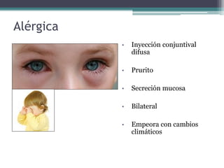 Alérgica
           •   Inyección conjuntival
               difusa

           •   Prurito

           •   Secreción mucosa

           •   Bilateral

           •   Empeora con cambios
               climáticos
 