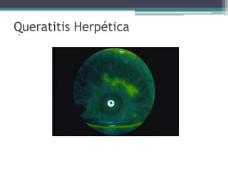 Queratitis Herpética
 .
 