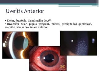 Uveítis Anterior
• Dolor, fotofobia, disminución de AV
• Inyección ciliar, pupila irregular, miosis, precipitados queráticos,
reacción celular en cámara anterior.
 