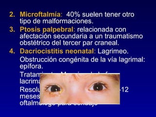 2. Microftalmía: 40% suelen tener otro
tipo de malformaciones.
3. Ptosis palpebral: relacionada con
afectación secundaria a un traumatismo
obstétrico del tercer par craneal.
4. Dacriocistitis neonatal: Lagrimeo.
Obstrucción congénita de la vía lagrimal:
epífora.
Tratamiento: Masajes de la fosa
lacrimal. Antibioterapia tópica.
Resolución espontánea en los 6-12
meses. Más de 12 meses
oftalmólogo para sondaje

 