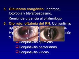 5. Glaucoma congénito: lagrimeo,
fotofobia y blefaroespasmo.
Remitir de urgencia al oltalmólogo.
6. Ojo rojo: oftalmía del RN. Conjuntivitis
aguda durante el primer mes de vida.
Hiperemia conjuntival bulbar, exudación
e inflamación palpebral.
 Conjuntivitis químicas.
 Conjuntivitis bacterianas.
 Conjuntivitis víricas.

 