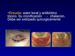 •Orzuelo: calor local y antibiótico
tópico. Su cronificación
chalacion.
Debe ser extirpado quirurgicamente

 
