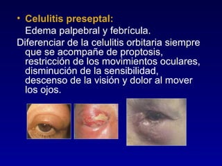 • Celulitis preseptal:
Edema palpebral y febrícula.
Diferenciar de la celulitis orbitaria siempre
que se acompañe de proptosis,
restricción de los movimientos oculares,
disminución de la sensibilidad,
descenso de la visión y dolor al mover
los ojos.

 