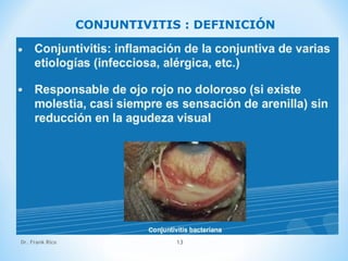 Dr. Frank Rico 13
CONJUNTIVITIS : DEFINICIÓN
 