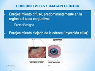 Dr. Frank Rico 14
CONJUNTIVITIS : IMAGEN CLÍNICA
 
