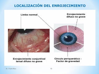 Dr. Frank Rico 15
LOCALIZACIÓN DEL ENROJECIMIENTO
 