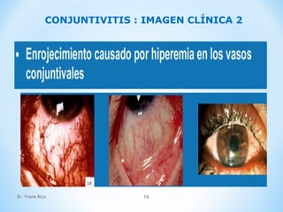 Dr. Frank Rico 16
CONJUNTIVITIS : IMAGEN CLÍNICA 2
 