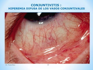 Dr. Frank Rico 17
CONJUNTIVITIS :
HIPEREMIA DIFUSA DE LOS VASOS CONJUNTIVALES
 