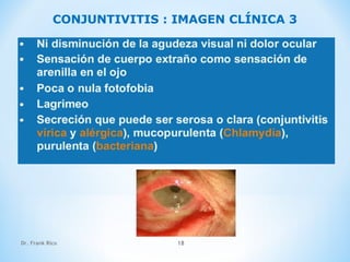 Dr. Frank Rico 18
CONJUNTIVITIS : IMAGEN CLÍNICA 3
 