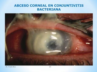 Dr. Frank Rico 24
ABCESO CORNEAL EN CONJUNTIVITIS
BACTERIANA
 
