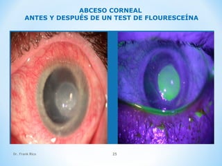 Dr. Frank Rico 25
ABCESO CORNEAL
ANTES Y DESPUÉS DE UN TEST DE FLOURESCEÍNA
 