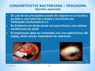 Dr. Frank Rico 30
CONJUNTIVITIS BACTERIANA : TRACHOMA
Opinión aplazada
 