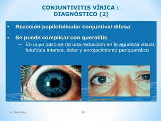 Dr. Frank Rico 33
CONJUNTIVITIS VÍRICA :
DIAGNÓSTICO (2)
 